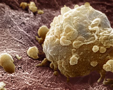 melanoma cancer cells